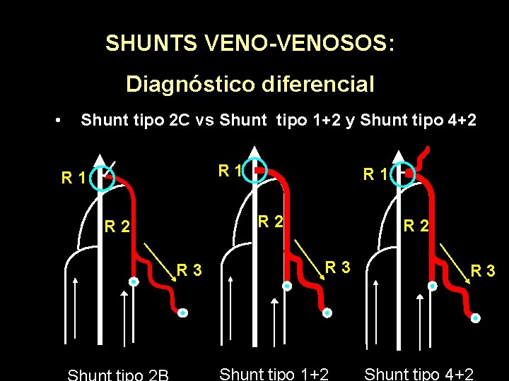 SHUNTS VENO-VENOSOS: Diagnóstico diferencial • Shunt tipo 2 C vs Shunt tipo 1+2 y