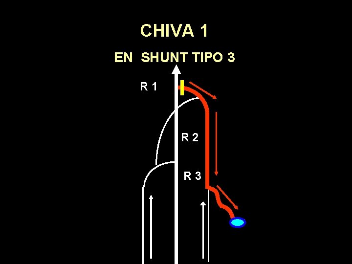 CHIVA 1 EN SHUNT TIPO 3 R 1 R 2 R 3 