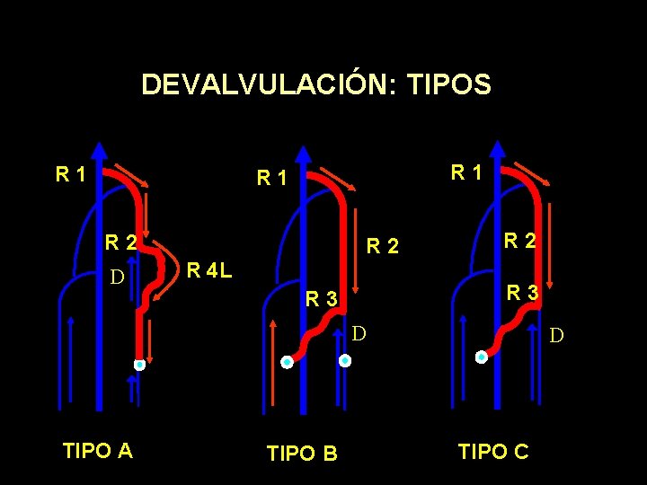 DEVALVULACIÓN: TIPOS R 1 R 1 R 2 D R 2 R 4 L