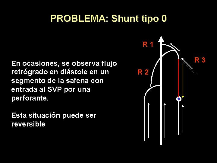 PROBLEMA: Shunt tipo 0 R 1 En ocasiones, se observa flujo retrógrado en diástole