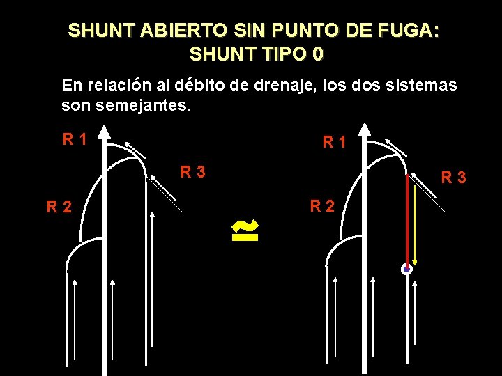 SHUNT ABIERTO SIN PUNTO DE FUGA: SHUNT TIPO 0 En relación al débito de