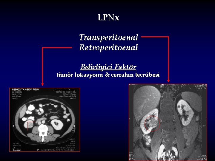 LPNx Transperitoenal Retroperitoenal Belirliyici Faktör tümör lokasyonu & cerrahın tecrübesi 