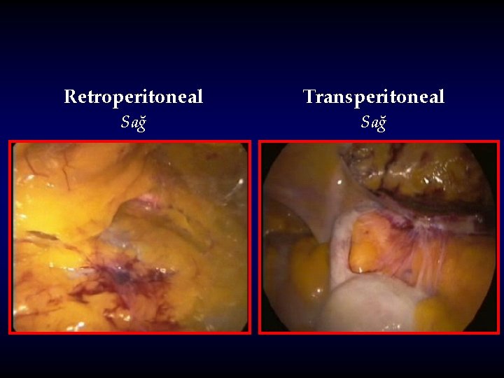 Retroperitoneal Transperitoneal Sağ 