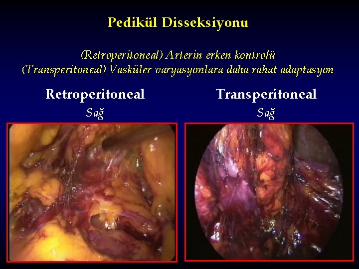 Pedikül Disseksiyonu (Retroperitoneal) Arterin erken kontrolü (Transperitoneal) Vasküler varyasyonlara daha rahat adaptasyon Retroperitoneal Transperitoneal