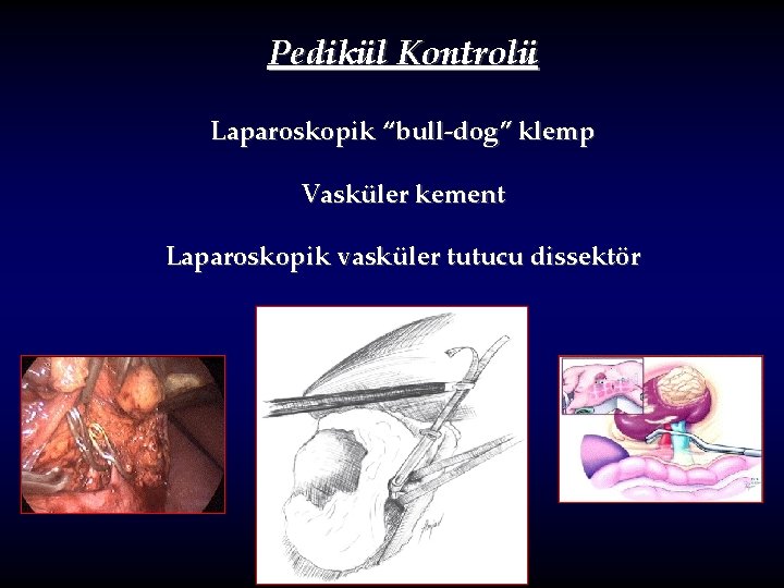 Pedikül Kontrolü Laparoskopik “bull-dog” klemp Vasküler kement Laparoskopik vasküler tutucu dissektör 