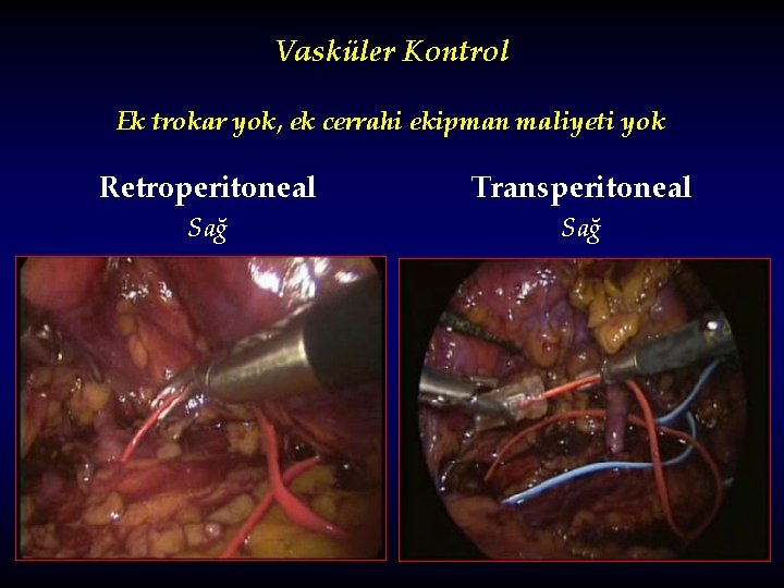 Vasküler Kontrol Ek trokar yok, ek cerrahi ekipman maliyeti yok Retroperitoneal Transperitoneal Sağ 