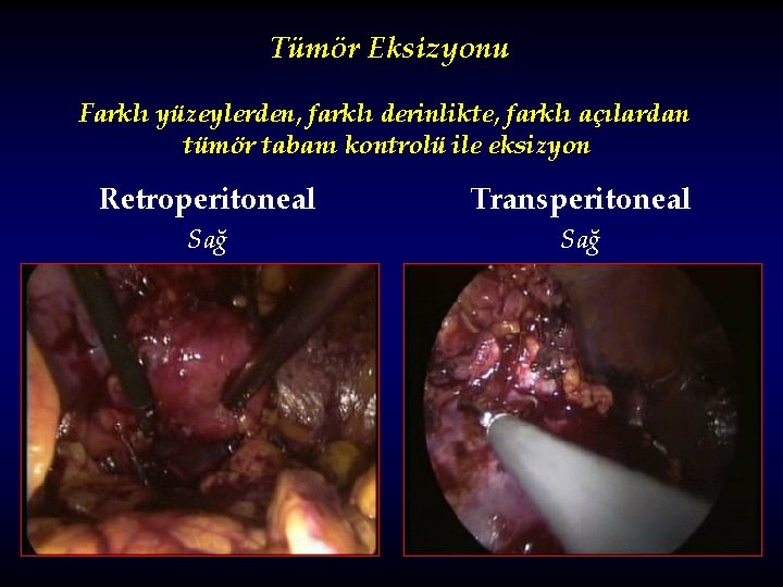 Tümör Eksizyonu Farklı yüzeylerden, farklı derinlikte, farklı açılardan tümör tabanı kontrolü ile eksizyon Retroperitoneal