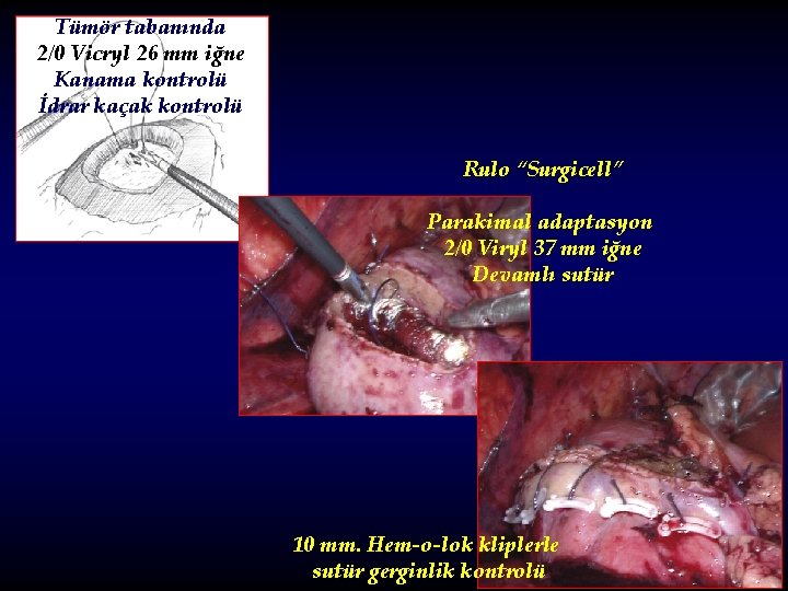 Tümör tabanında 2/0 Vicryl 26 mm iğne Kanama kontrolü İdrar kaçak kontrolü Rulo “Surgicell”