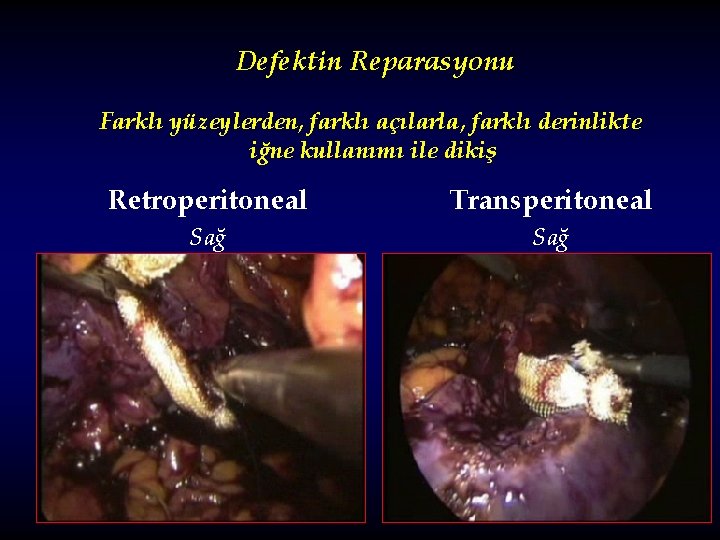 Defektin Reparasyonu Farklı yüzeylerden, farklı açılarla, farklı derinlikte iğne kullanımı ile dikiş Retroperitoneal Transperitoneal