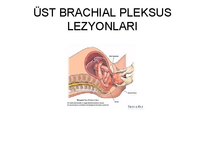ÜST BRACHIAL PLEKSUS LEZYONLARI 