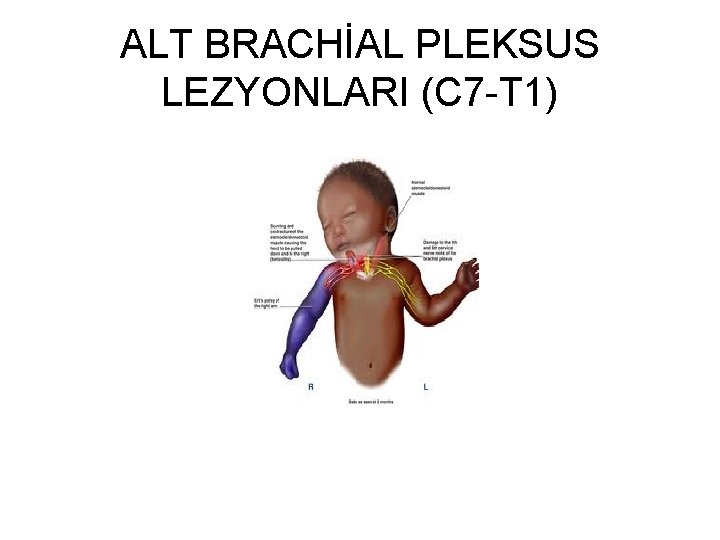 ALT BRACHİAL PLEKSUS LEZYONLARI (C 7 -T 1) 