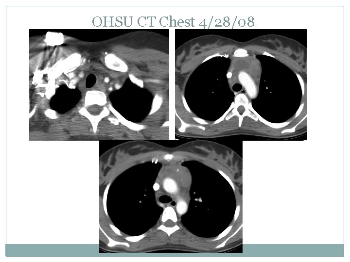 OHSU CT Chest 4/28/08 