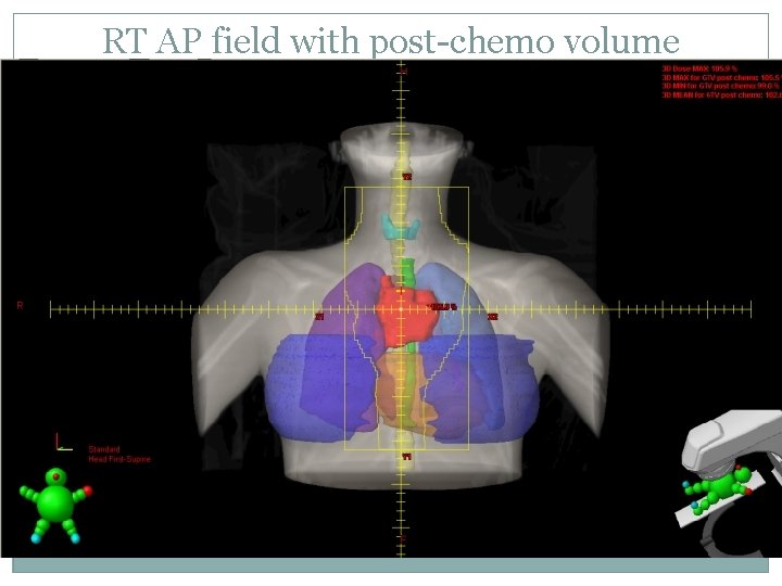 RT AP field with post-chemo volume 