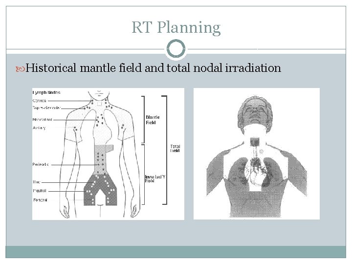 RT Planning Historical mantle field and total nodal irradiation 