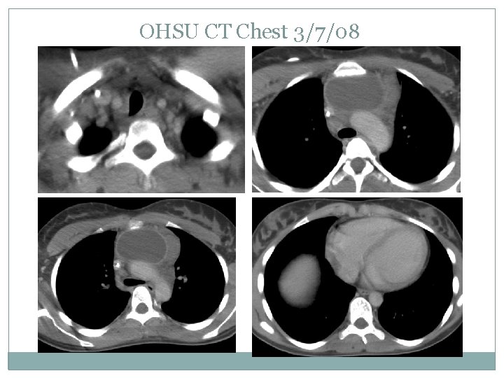 OHSU CT Chest 3/7/08 