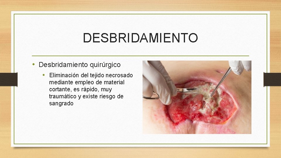 DESBRIDAMIENTO • Desbridamiento quirúrgico • Eliminación del tejido necrosado mediante empleo de material cortante,