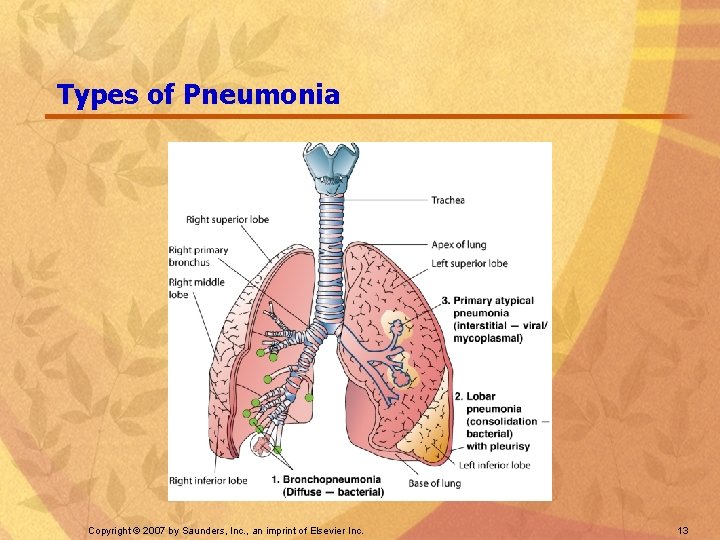 Types of Pneumonia Copyright © 2007 by Saunders, Inc. , an imprint of Elsevier