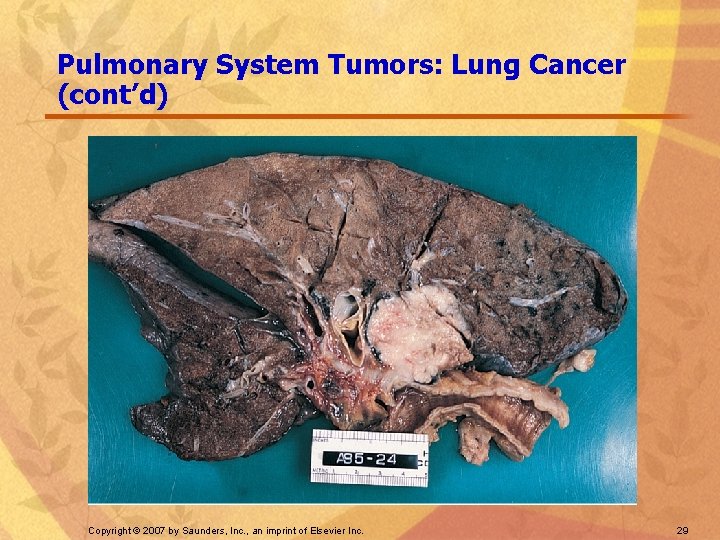 Pulmonary System Tumors: Lung Cancer (cont’d) Copyright © 2007 by Saunders, Inc. , an