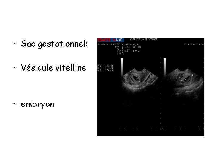  • Sac gestationnel: • Vésicule vitelline • embryon 