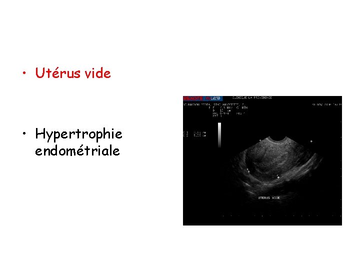  • Utérus vide • Hypertrophie endométriale 