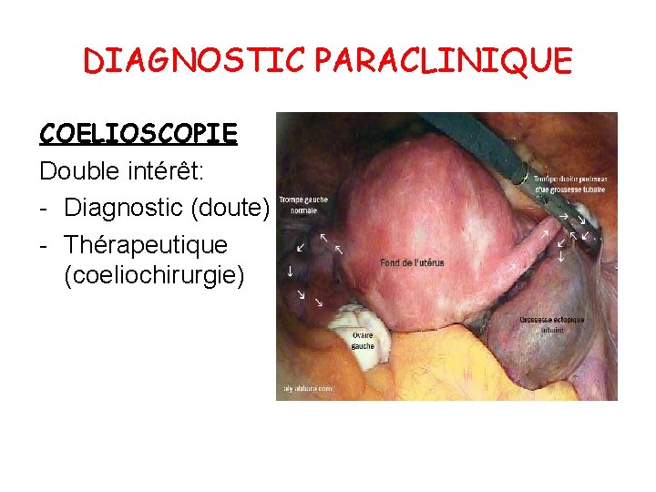 DIAGNOSTIC PARACLINIQUE COELIOSCOPIE Double intérêt: - Diagnostic (doute) - Thérapeutique (coeliochirurgie) 