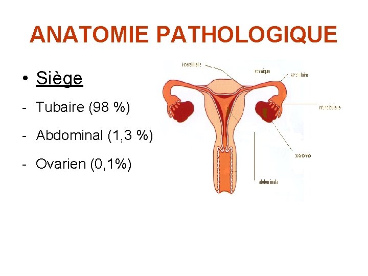 ANATOMIE PATHOLOGIQUE • Siège - Tubaire (98 %) - Abdominal (1, 3 %) -