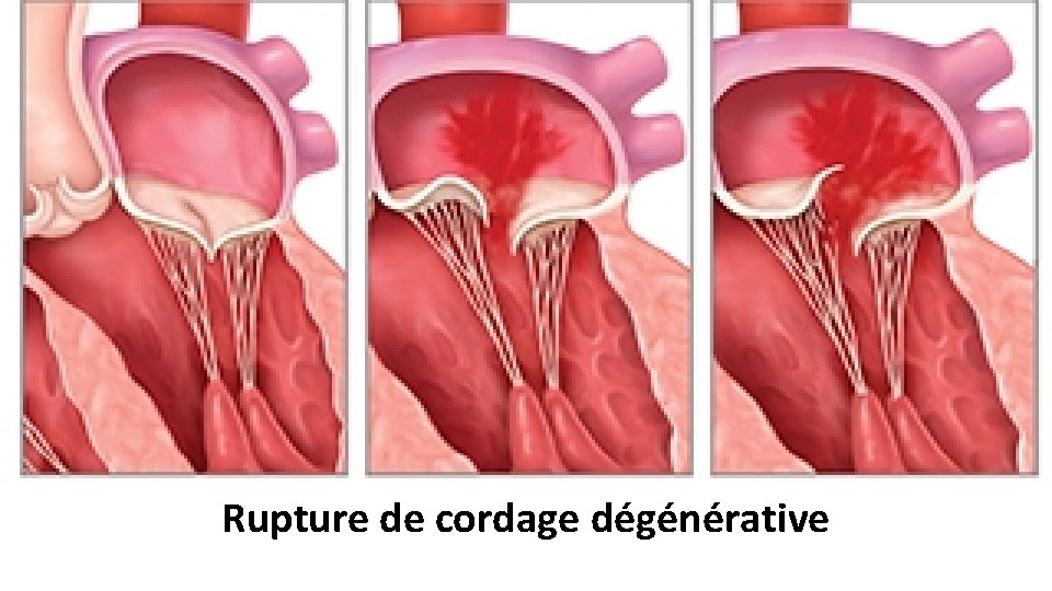 Rupture de cordage dégénérative 