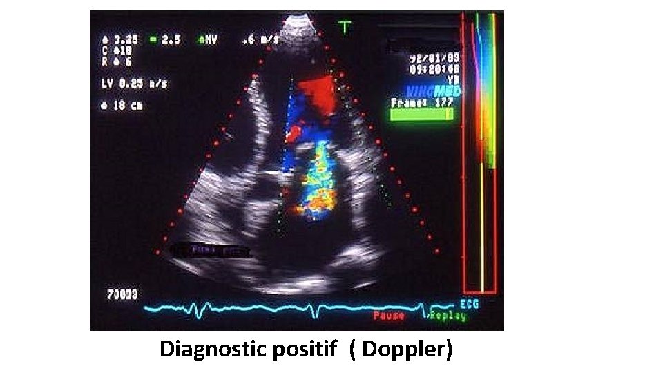 Diagnostic positif ( Doppler) 