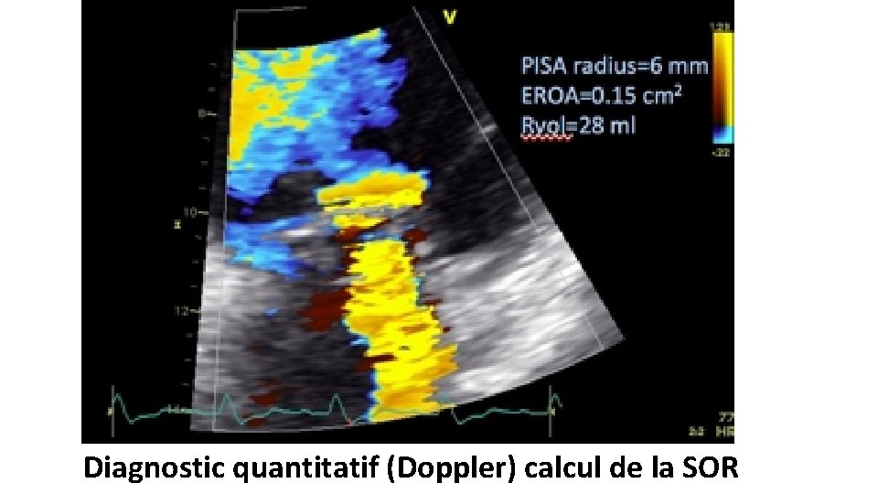 Diagnostic quantitatif (Doppler) calcul de la SOR 