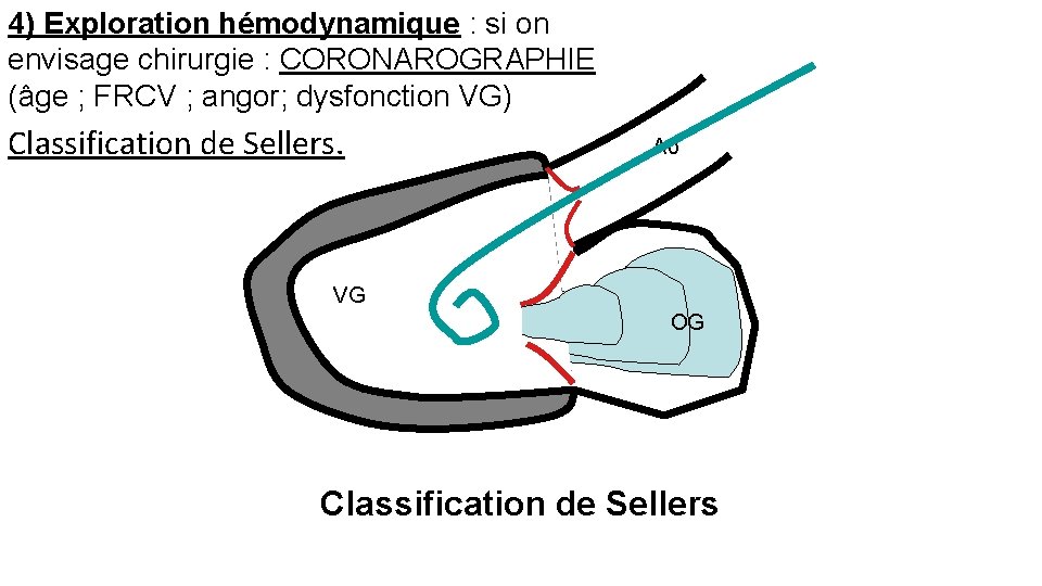 4) Exploration hémodynamique : si on envisage chirurgie : CORONAROGRAPHIE (âge ; FRCV ;