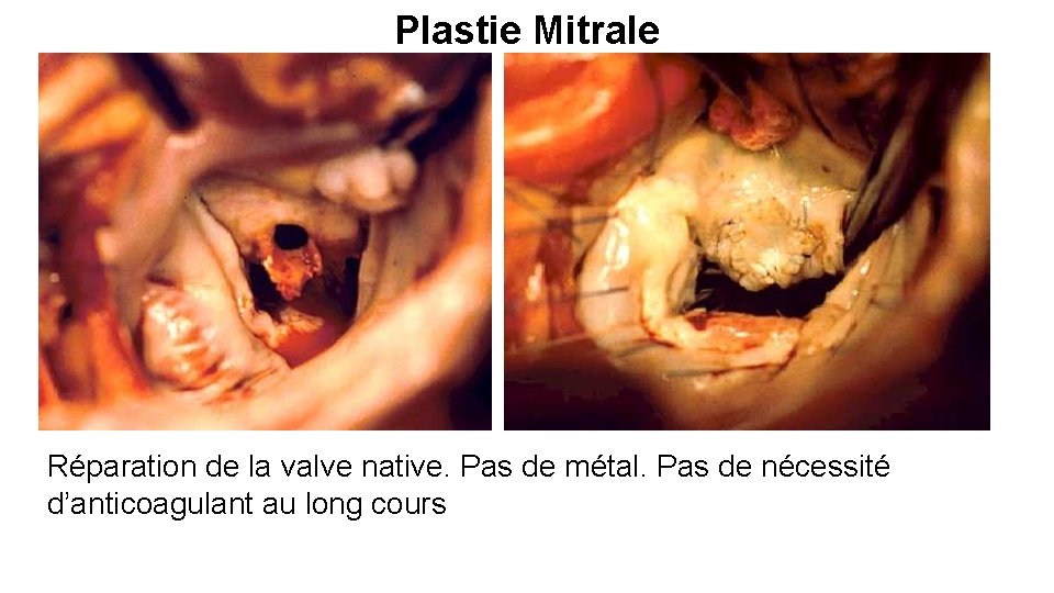 Plastie Mitrale Réparation de la valve native. Pas de métal. Pas de nécessité d’anticoagulant