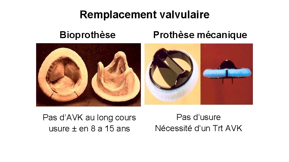 Remplacement valvulaire Bioprothèse Prothèse mécanique Pas d’AVK au long cours usure ± en 8