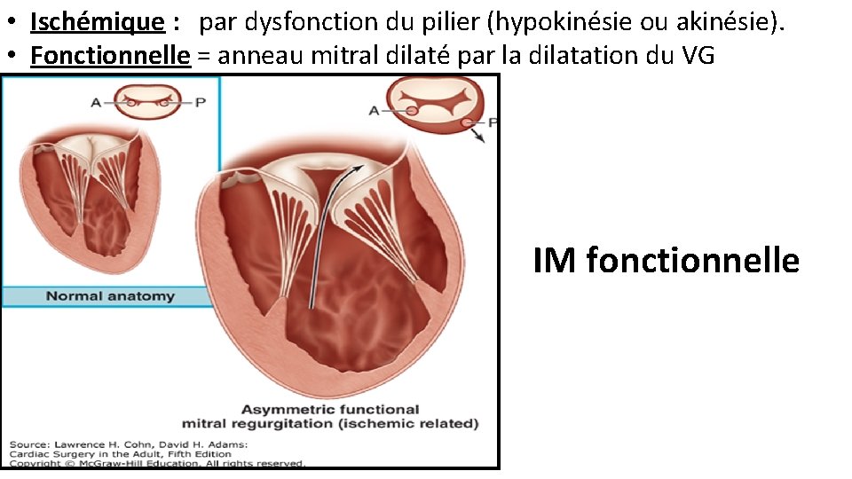  • Ischémique : par dysfonction du pilier (hypokinésie ou akinésie). • Fonctionnelle =