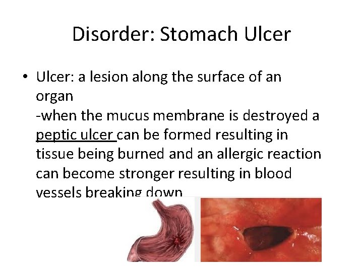 Disorder: Stomach Ulcer • Ulcer: a lesion along the surface of an organ -when