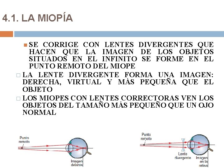 4. 1. LA MIOPÍA SE CORRIGE CON LENTES DIVERGENTES QUE HACEN QUE LA IMAGEN 4. 1. LA MIOPÍA SE CORRIGE CON LENTES DIVERGENTES QUE HACEN QUE LA IMAGEN