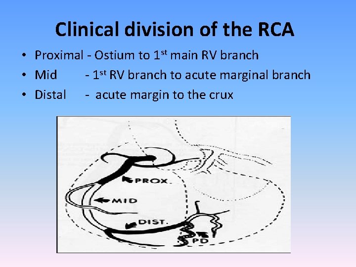 Clinical division of the RCA • Proximal - Ostium to 1 st main RV