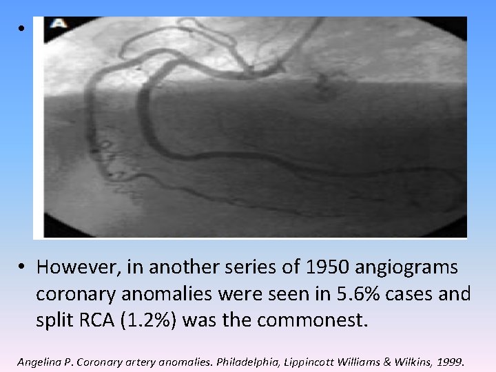  • The most common coronary variation (Cleveland Clinic-1, 26, 000 patients) was separate