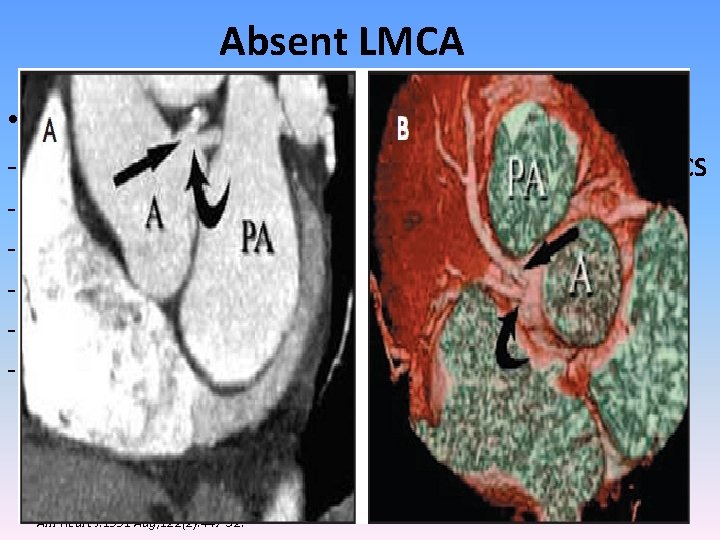 Absent LMCA • ~0. 4% - 1 ostia at the LCS/ 2 ostia in