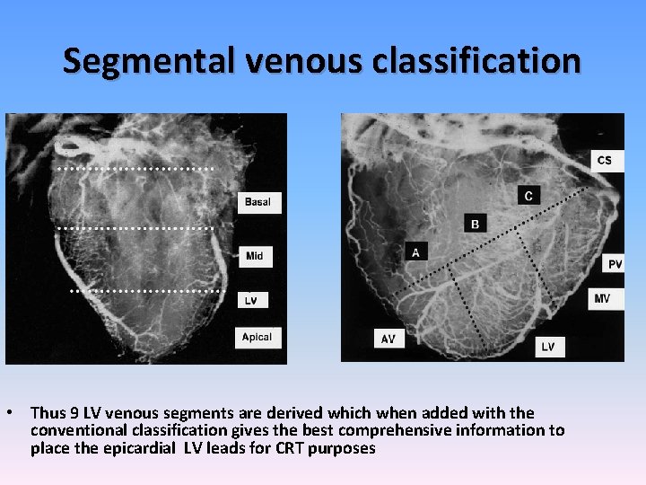 Segmental venous classification • Thus 9 LV venous segments are derived which when added