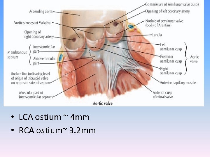  • LCA ostium ~ 4 mm • RCA ostium~ 3. 2 mm 