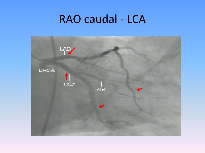 RAO caudal - LCA 