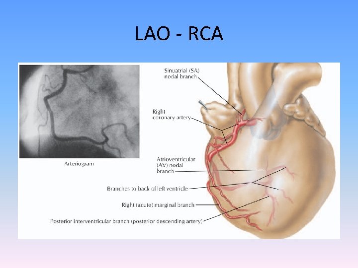 LAO - RCA 