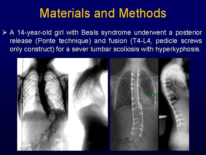 Materials and Methods A 14 -year-old girl with Beals syndrome underwent a posterior release