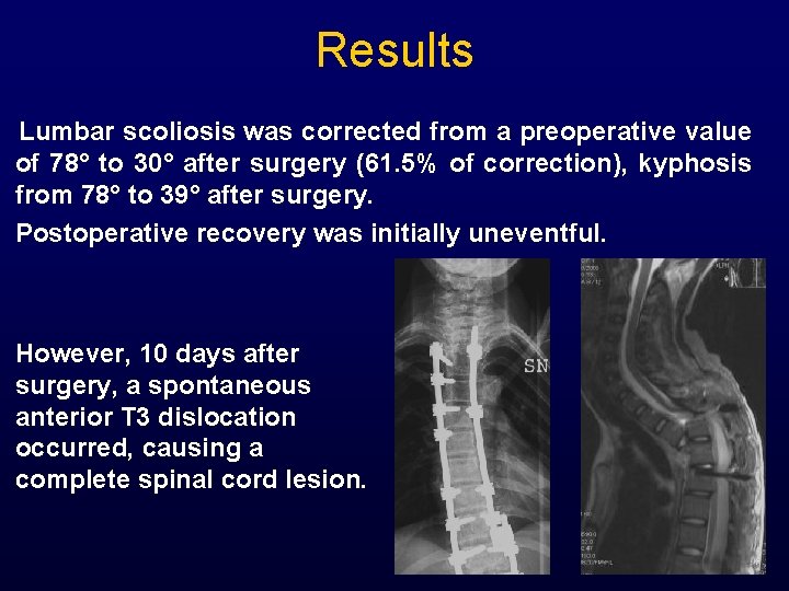 Results Lumbar scoliosis was corrected from a preoperative value of 78° to 30° after