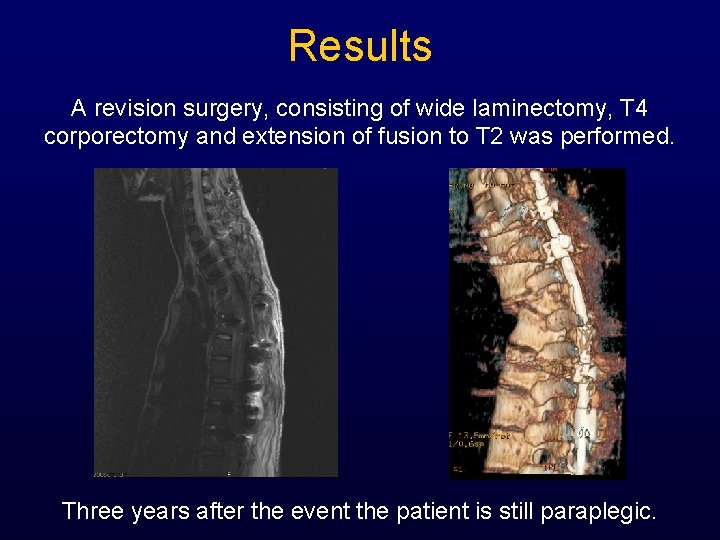 Results A revision surgery, consisting of wide laminectomy, T 4 corporectomy and extension of