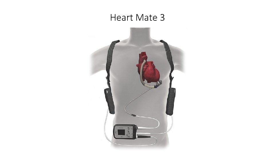 Heart Mate 3 