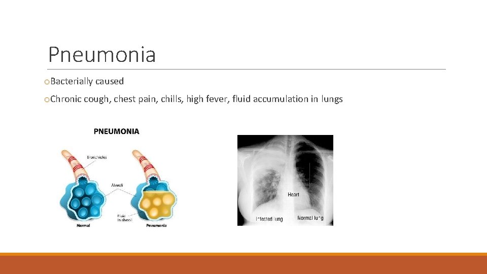 Pneumonia o. Bacterially caused o. Chronic cough, chest pain, chills, high fever, fluid accumulation