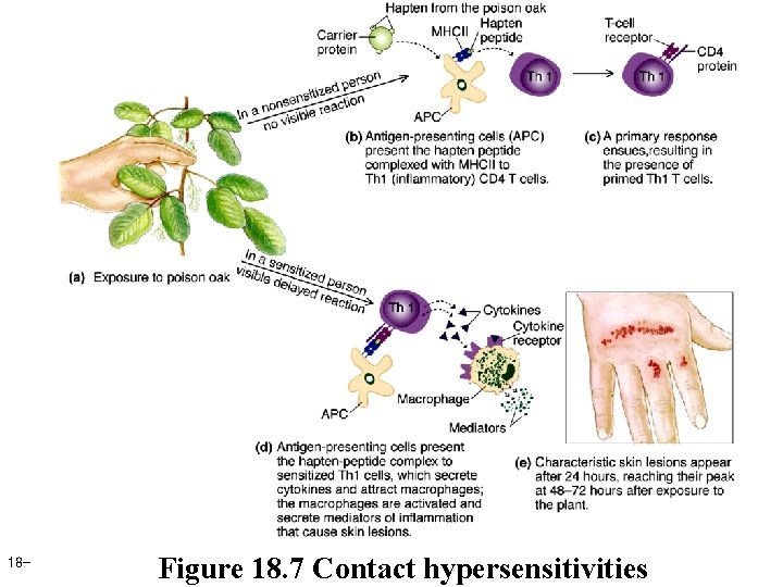 18 - Figure 18. 7 Contact hypersensitivities 