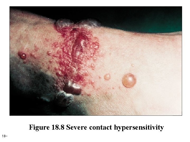 Figure 18. 8 Severe contact hypersensitivity 18 - 