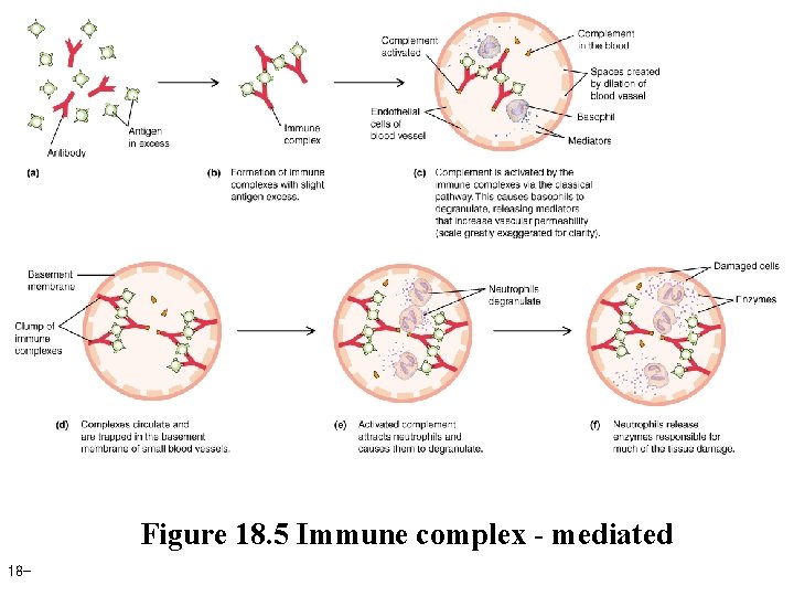 Figure 18. 5 Immune complex - mediated 18 - 